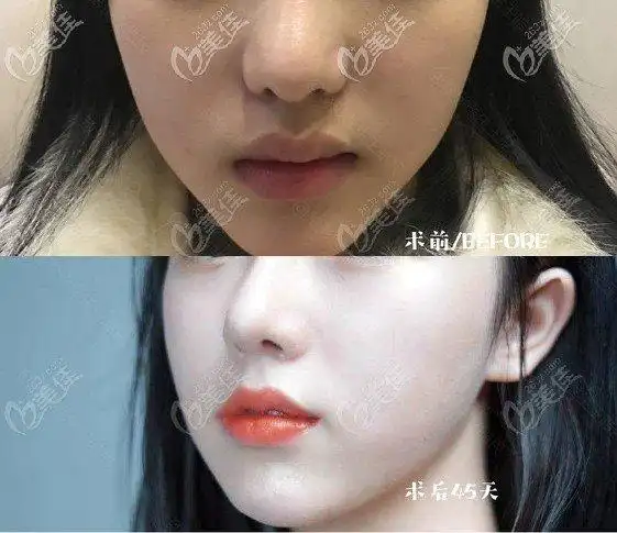 海鸥唇,形态特点:嘴唇饱满,双m线,屁股唇,品字形唇珠,菱形嘴角海鸥唇