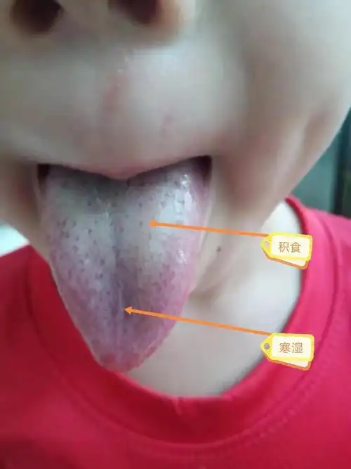 孩子积食腹胀咳嗽的舌象