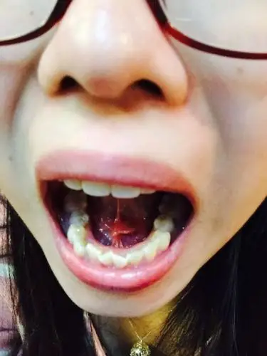 舌根处有个肉疙瘩