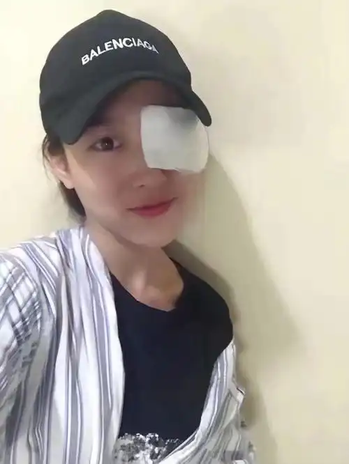 icl晶体植入近视眼手术