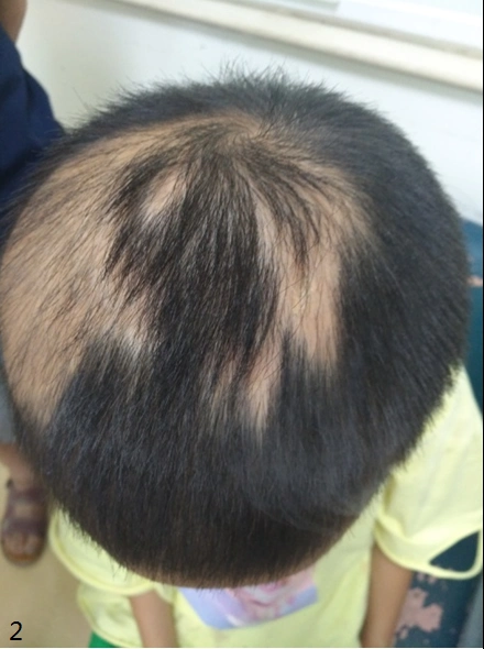 宝宝有苦说不出浅谈精神行为障碍性儿童皮肤病拔毛癖