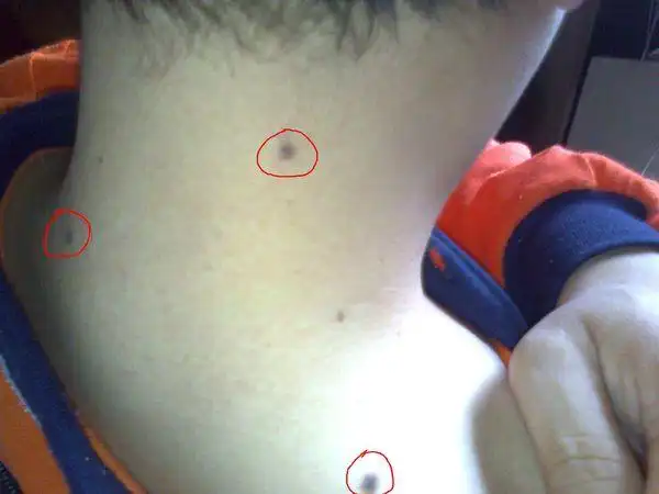 脖子有两颗痣,肩膀也有一颗,代表什么?本人男