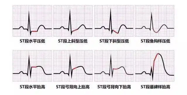 简单4步读懂心电图stt段改变特点