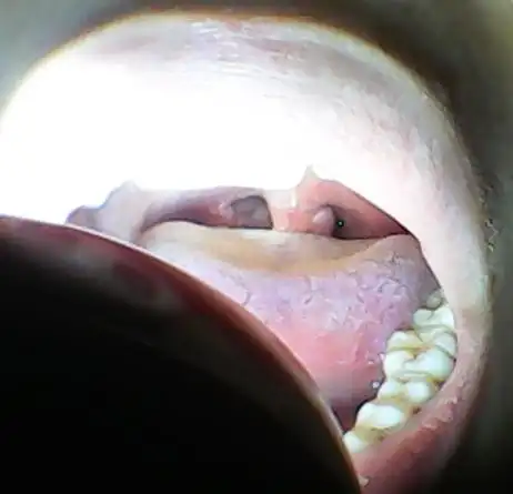 喉咙小舌头有一个球 不疼不痒不影响吃东西 只是咽东西的时候感觉不