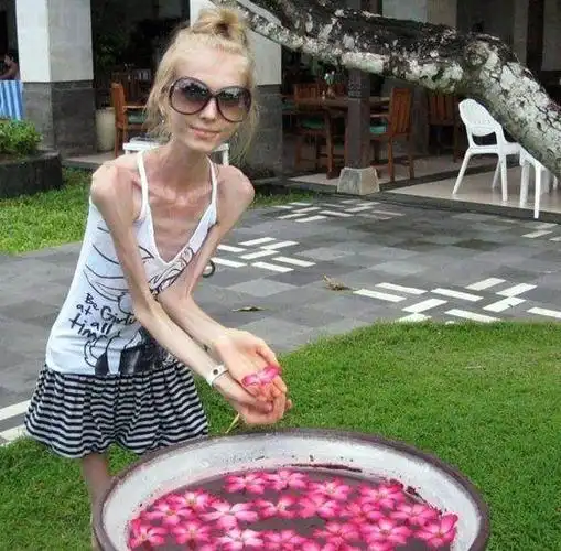 女孩用禁食法减肥,患上厌食症,瘦到四十斤