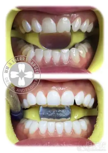 牙齿美白作品学员实践作品【学员培训美牙作品】