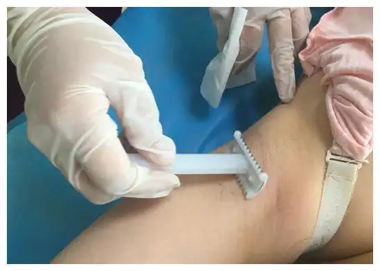 产妇不想备皮选剖腹产,医生:剖腹产也躲不过|剖宫产|顺产|手术_网易