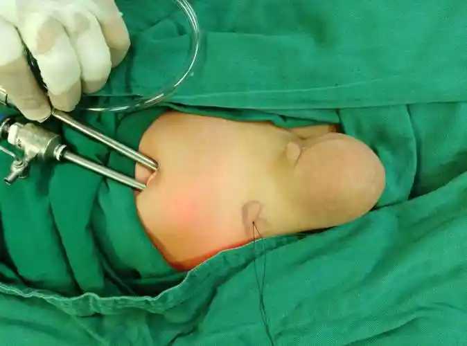 自肚脐入路腹腔镜儿童疝手术的优势