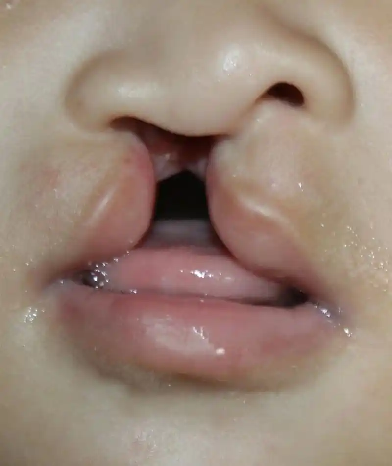 如果一个家族中有人患有兔唇,那么下一代患兔唇的风险会增加.