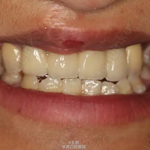 唇腭裂术后修复一例