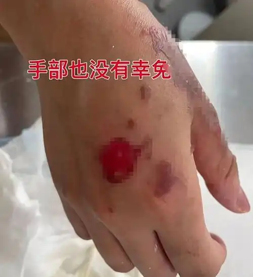 女孩吃饭被服务员放火烧身致毁容原因曝光后评论区反转她活该