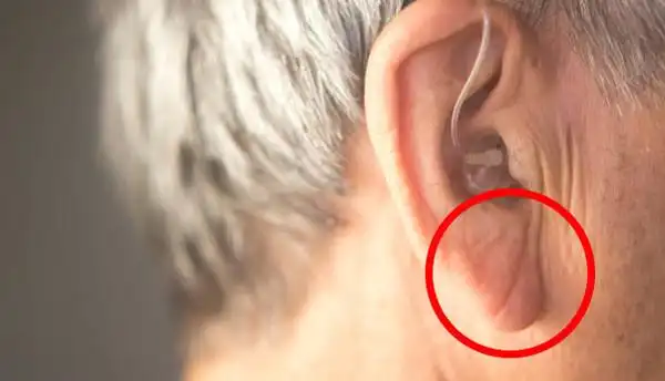 快检查耳朵!这个位置有褶痕 可能是心肌梗塞的徵兆