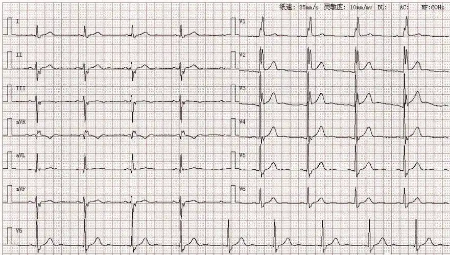 图结论:窦性心律完全性右束支传导阻滞左前分支传导阻滞st-t改变分析