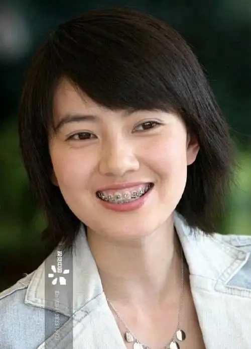 图片分别为高圆圆早期矫正牙齿前,戴牙套时期,矫正牙齿后