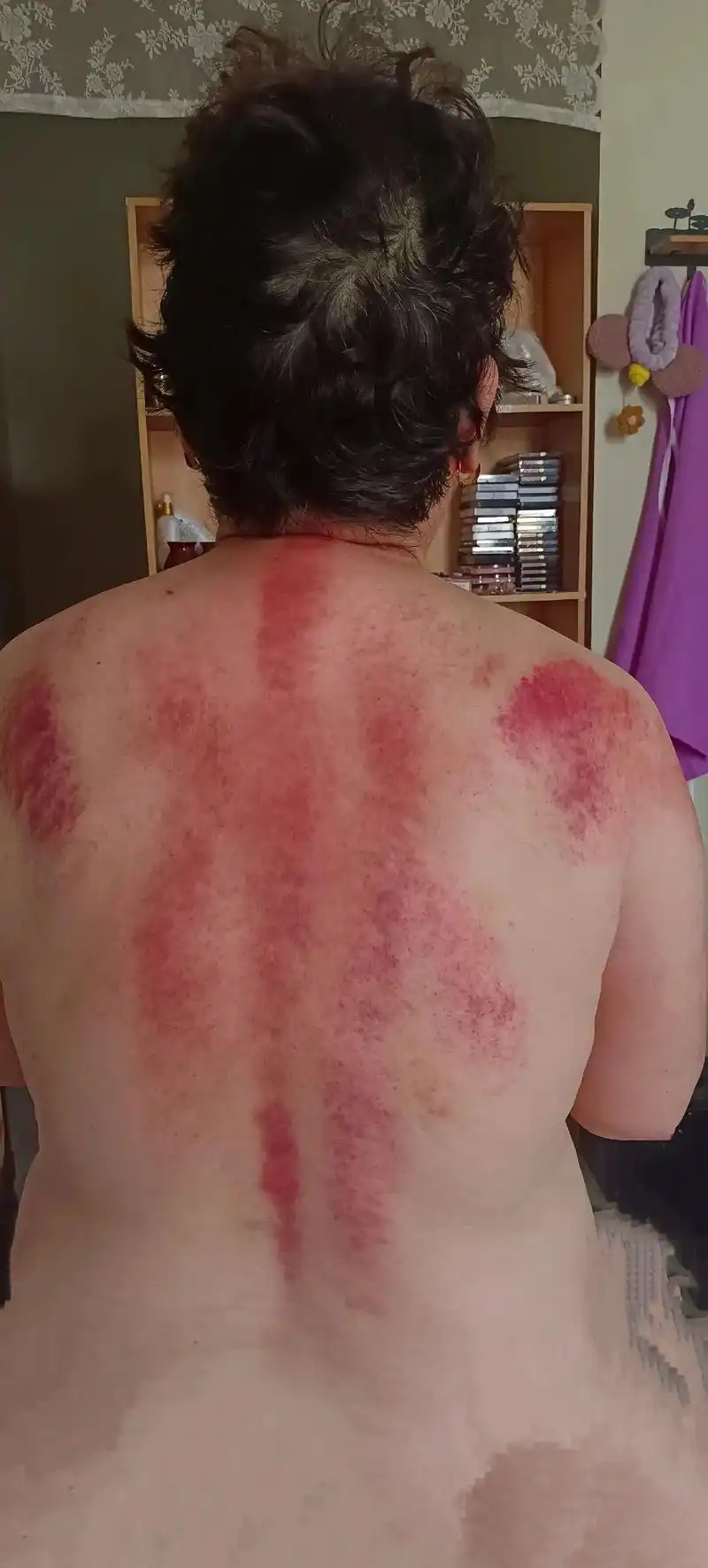 顾客做背调理 肩颈,淤堵,黏连.78  灸痧78  灸痧=刮痧  - 抖音