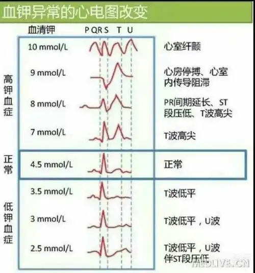 诊断:高钾引起窦室传导 心电图示:p波消失,qrs增宽,t波高尖,考虑高钾