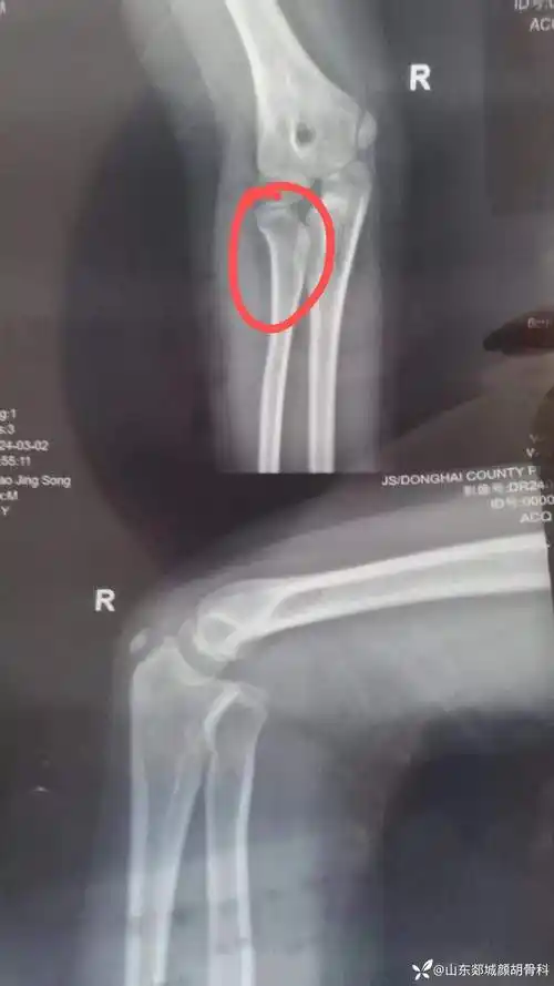 右桡骨小头脱位是先天性的还是外伤后引发