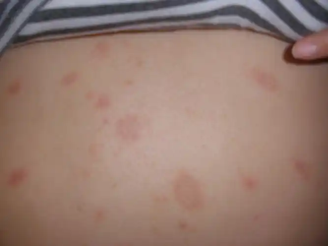 这是什么病 - 皮肤及性传播疾病讨论版 - 爱爱医医学论坛