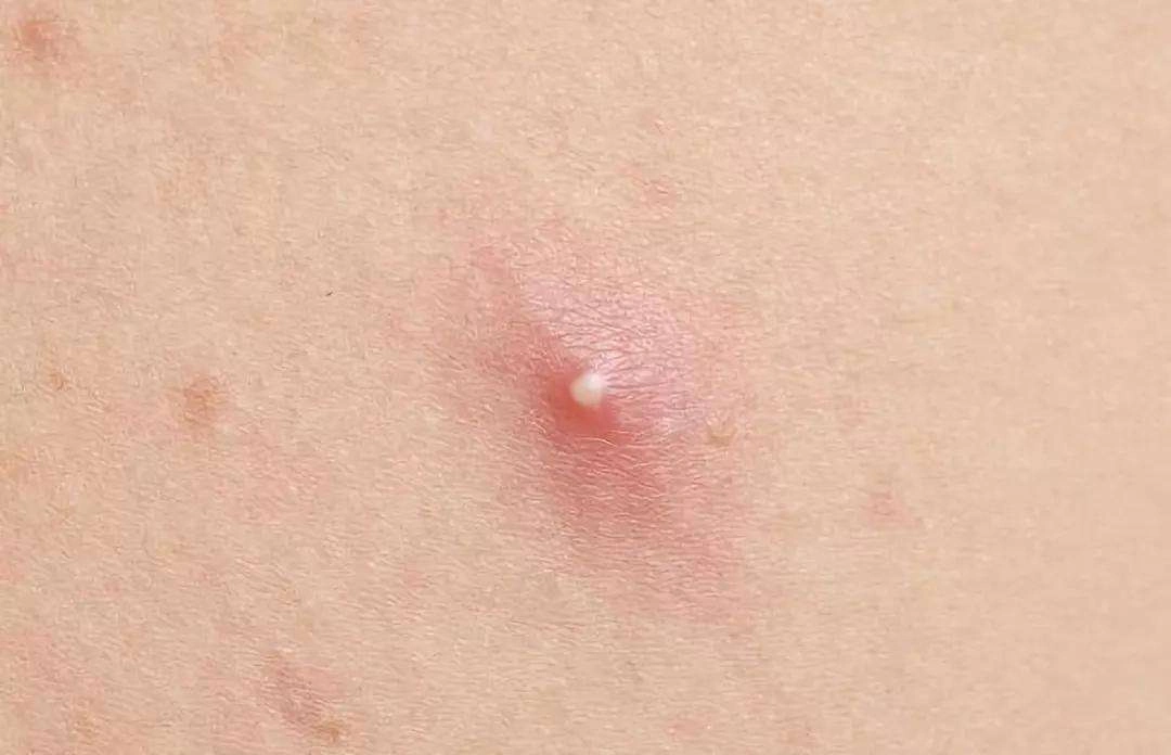 女性身上长1种小疙瘩,很可能是感染上hpv,最好能早点重视