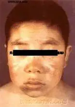 成人粘液性水肿