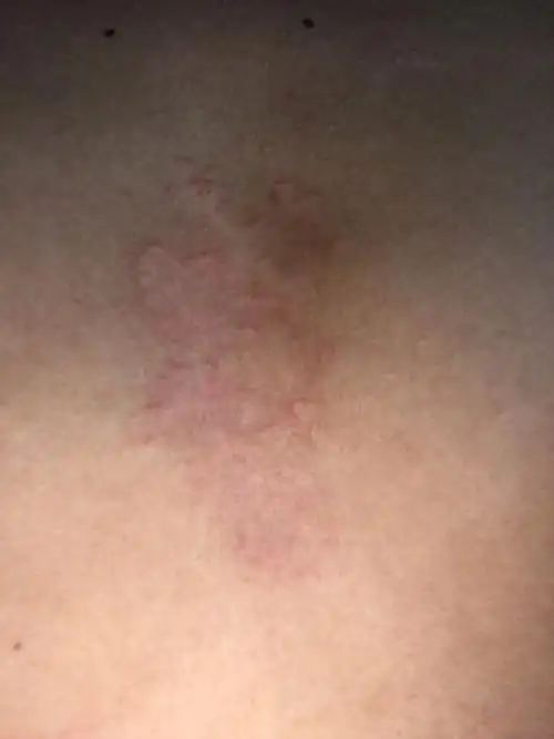 胸口起这样的红斑 痒 而且抓还有皮 刚开始没注意