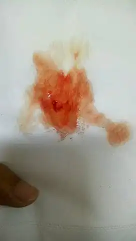 怀孕初期流血是这个颜色的正常吗