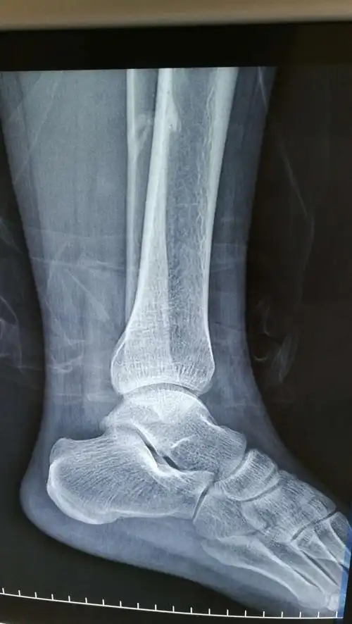 一例不寻常的踝骨折