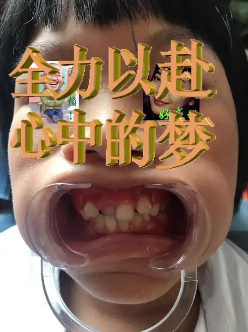 牙齿不齐～微正畸案例分享