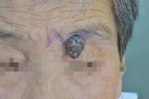 一老人脸上长了30年的黑痣突然破溃流血一查竟是