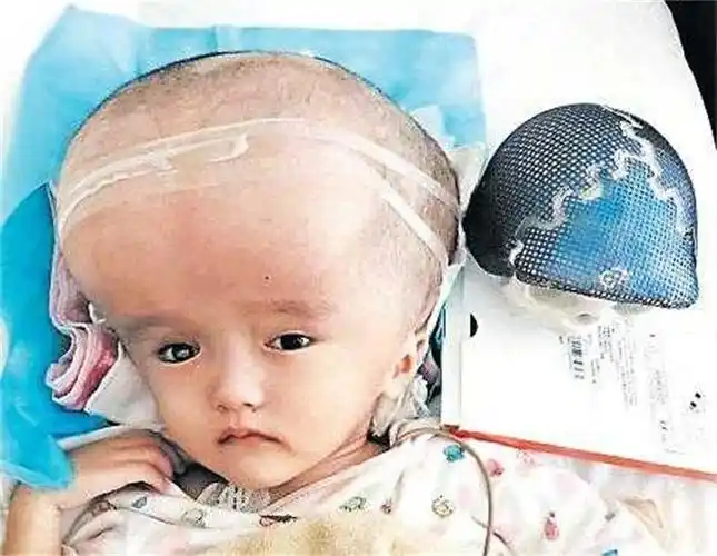 三鹿奶粉造成的危害三鹿奶粉大头娃娃现状