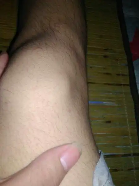 平时我跑步,骑自行车,运动量有点大,最近发现膝盖这个地方骨头突出,求