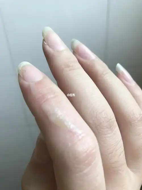 手被烫起泡,好难受会不会留疤?