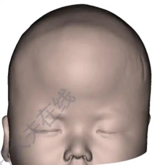 冠状缝早闭_狭颅症 - 好大夫在线