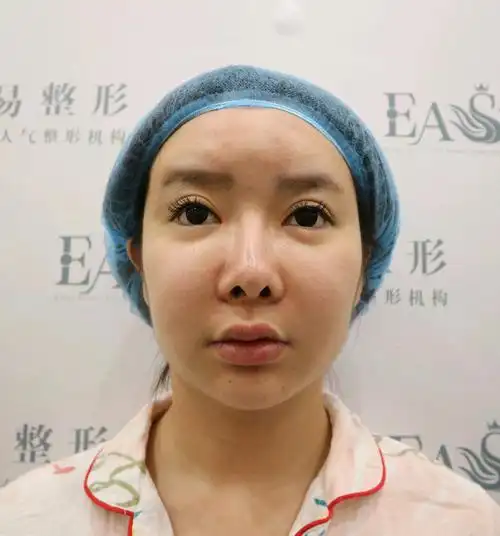 后来在网上看了许多家还是觉得容易整形的人中缩短案例真实比较多,最