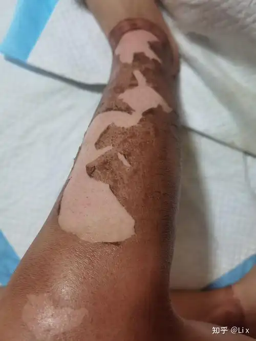 浅二度深二度混合烧伤恢复过程有图慎点