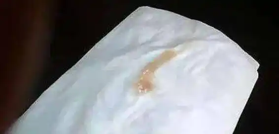 内裤上黄色分泌物是怎么回事六种情况要警惕尤其是第3种