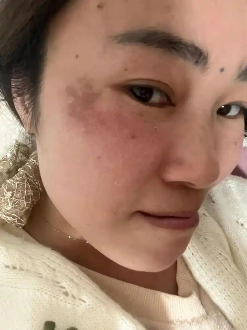 黄褐斑.但凡是长这个一片一片的,都是因为生气的太多,委屈太多 - 抖音