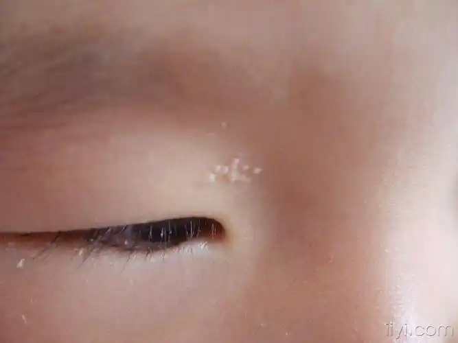 典型病例2__粟丘疹