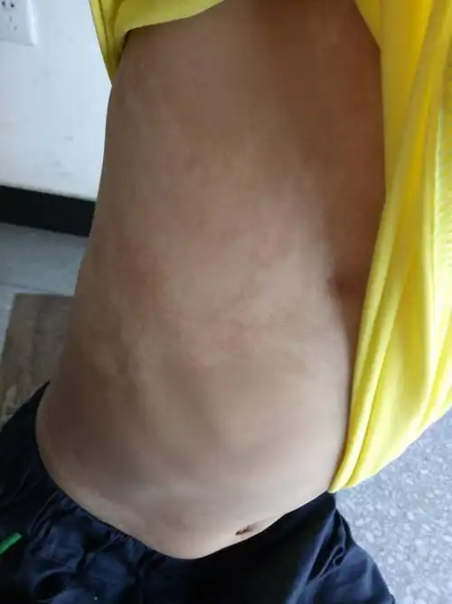 小孩皮肤上长白斑,有扩散的迹象,是什么?