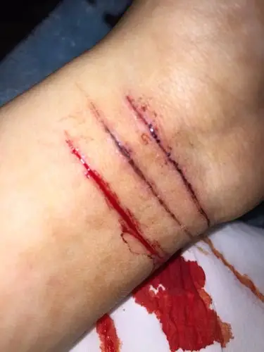 我得了抑郁症 不自觉就会有自杀的念头 今天这是第二刀 我恨那个伤害