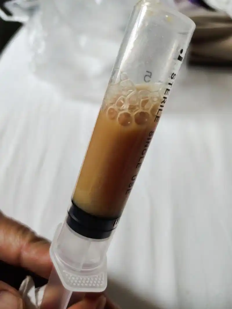 抽过胸腔积液后,我的情况好多了,不咳嗽也不发热.