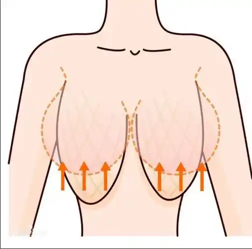 胸部下垂乳房下垂的调整方式有哪些