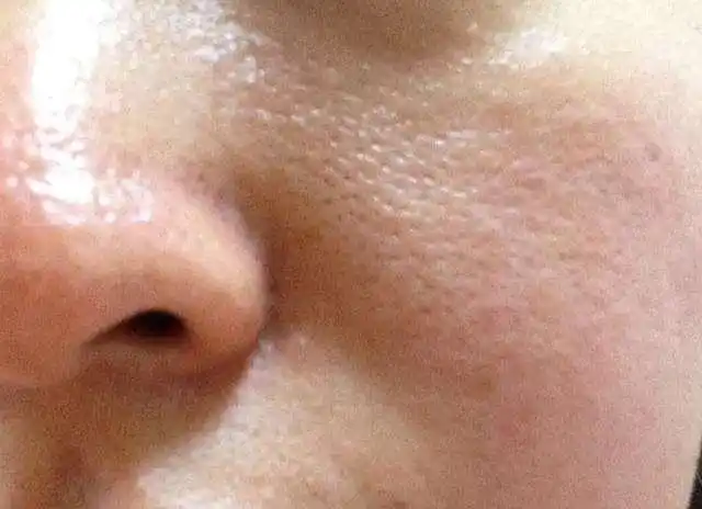 女生一旦毛孔粗大那就不好看了坚持2点轻松解决毛孔粗大问题