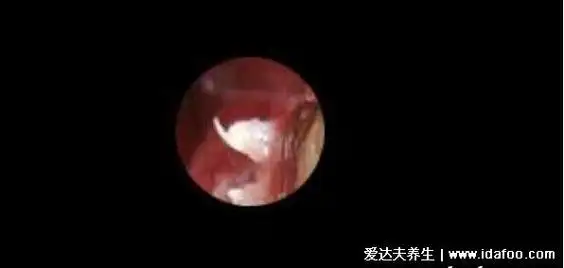 这是女性早期的小疣体,多长在yd,阴唇,肛门,宫颈内或者是尿道口,早期