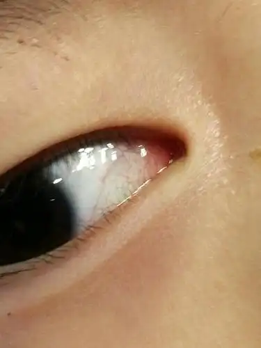 儿童男童4周岁多眼睛眼白有血丝,有时有眼泪,请问怎么办