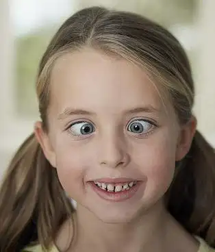 斗鸡眼 ,一种斜视性的眼球