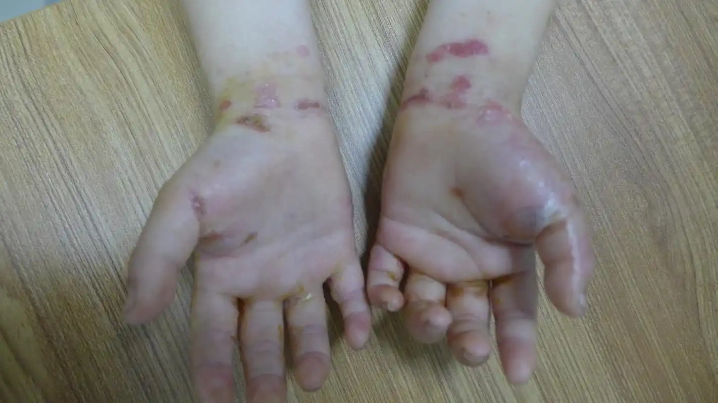 儿童疱疹样皮炎如何治疗