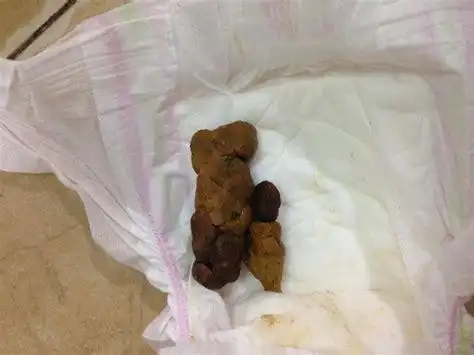 孕妇大便出血怎么办吃什么