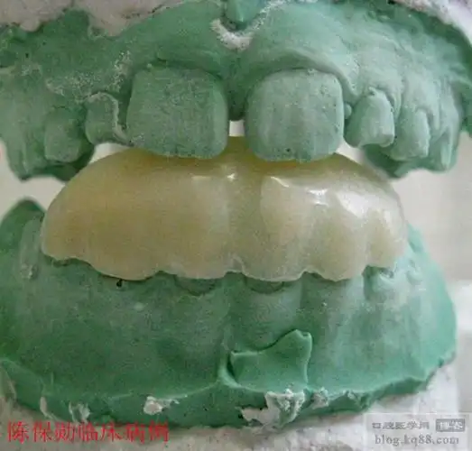 改良式下颌斜面导板---陈保勋