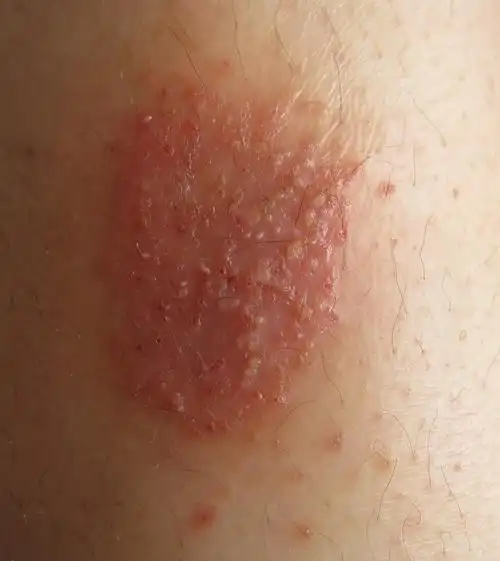 请问这是湿疹还是体廯?